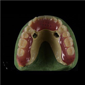 Peek Framework proteza