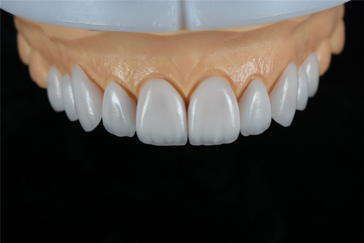 Natural Looking And Aesthetic Emax Veneer
