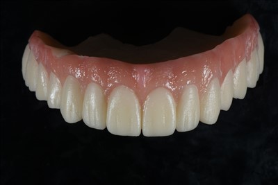 Privremena kruna od akrilne smole