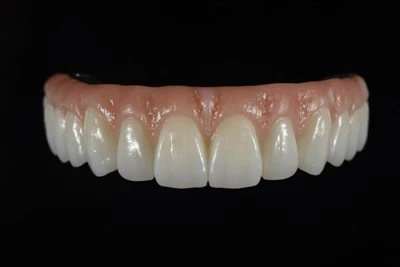 Digitalno dizajnirano sve-na-X Zirconia mostu
